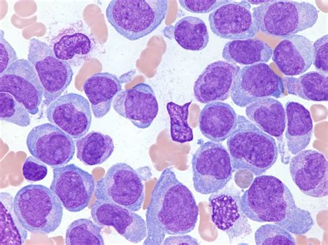 Acute Myeloid Leukaemia (AML cancer) .